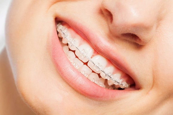Ortodonzia a Milano: apparecchi e bite dentali - Studio Dentistico